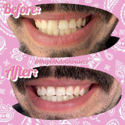 Teeth Whitening, Tooth Gems 