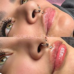 Lip Filler