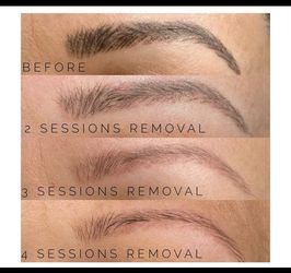 Microbladding Brow Removal
