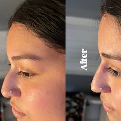 Nose Filler 
