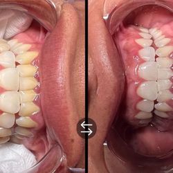 Teeth Whitening