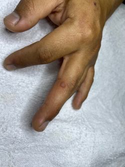finger warts Gone