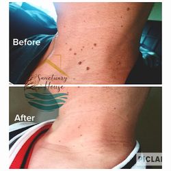 Skin tag removal