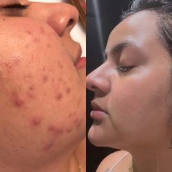 Bálsamo de la juventud, dile adiós al acné