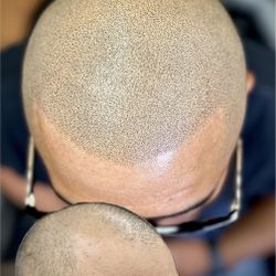 Hair Loss - Scalp Micropigmentation