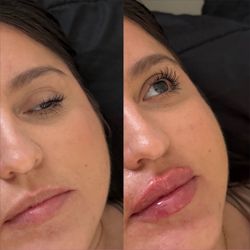 Lip filler