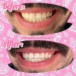 Tooth Gem, Teeth Whitening, Swarovski