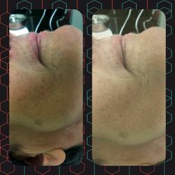 Facial,peel,microdermaprssion