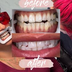 Teeth Whitening