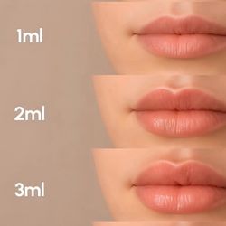 Lip Filler