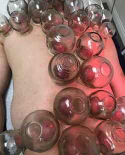 Back pain cupping therapy