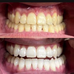 Teeth Whitening