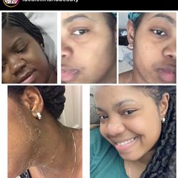 Surgical incision Fade Cream