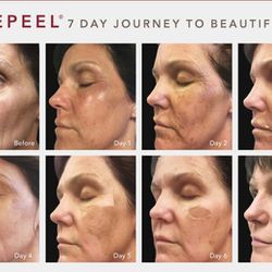 Revepeel Skincare
