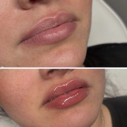 LIP FILLER 