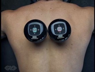 Cupping therapy