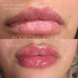 Lip Filler 