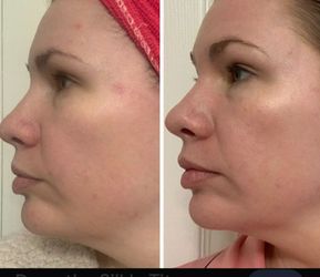 Radio frequency  Skin-tightening device *like new*