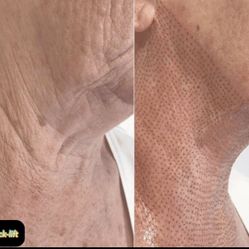Neck Lift 