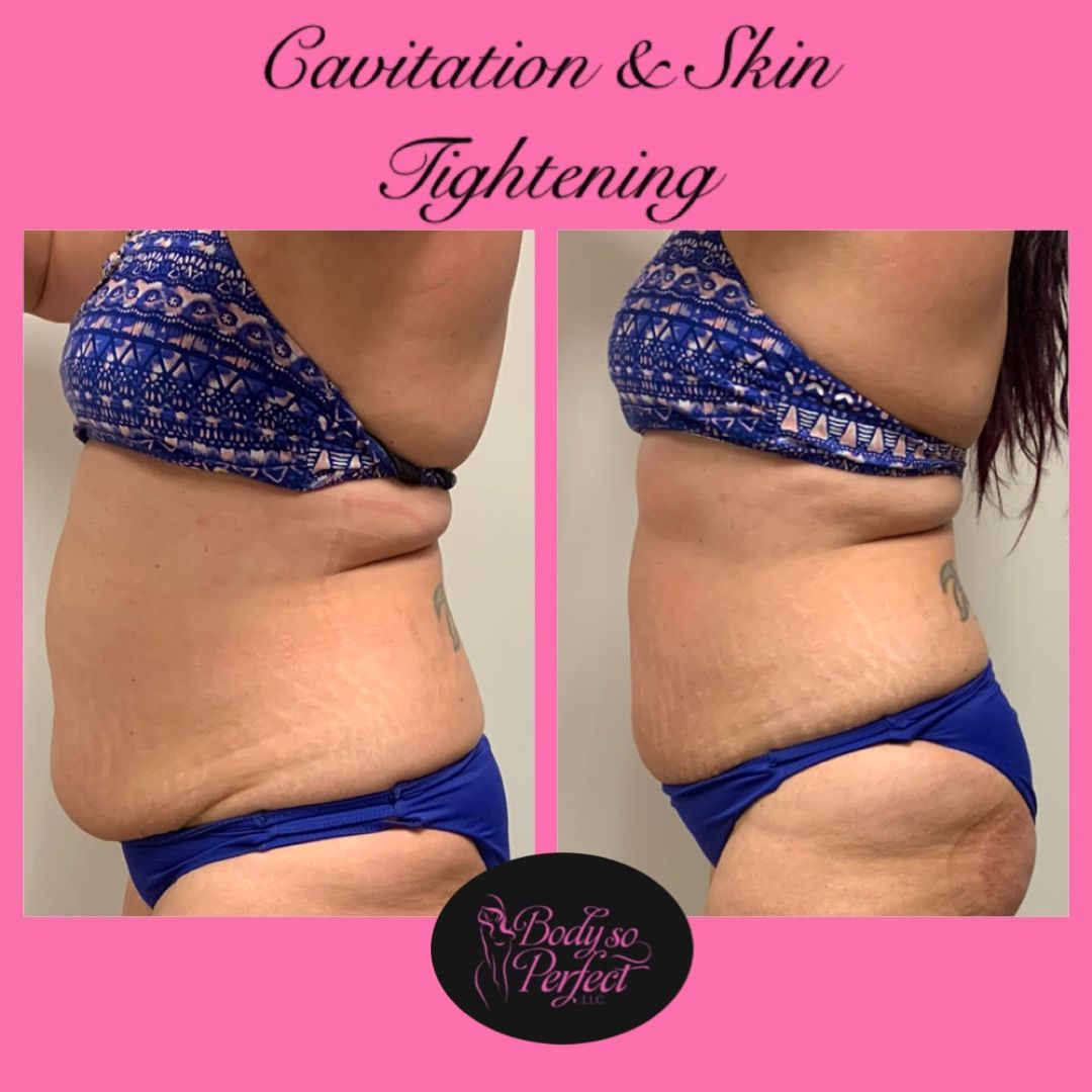 Laser lipo and cavitation