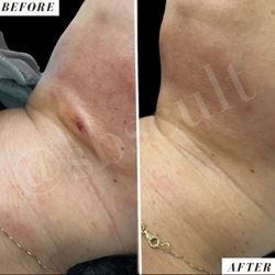 Lymphatic Drainage Post Op Supplies