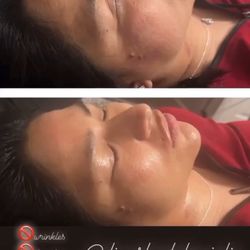 Skin Tightening