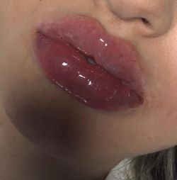 Lip filler