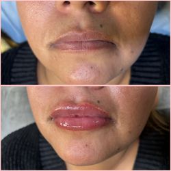Lips / Aumento