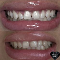 Teeth Whitening