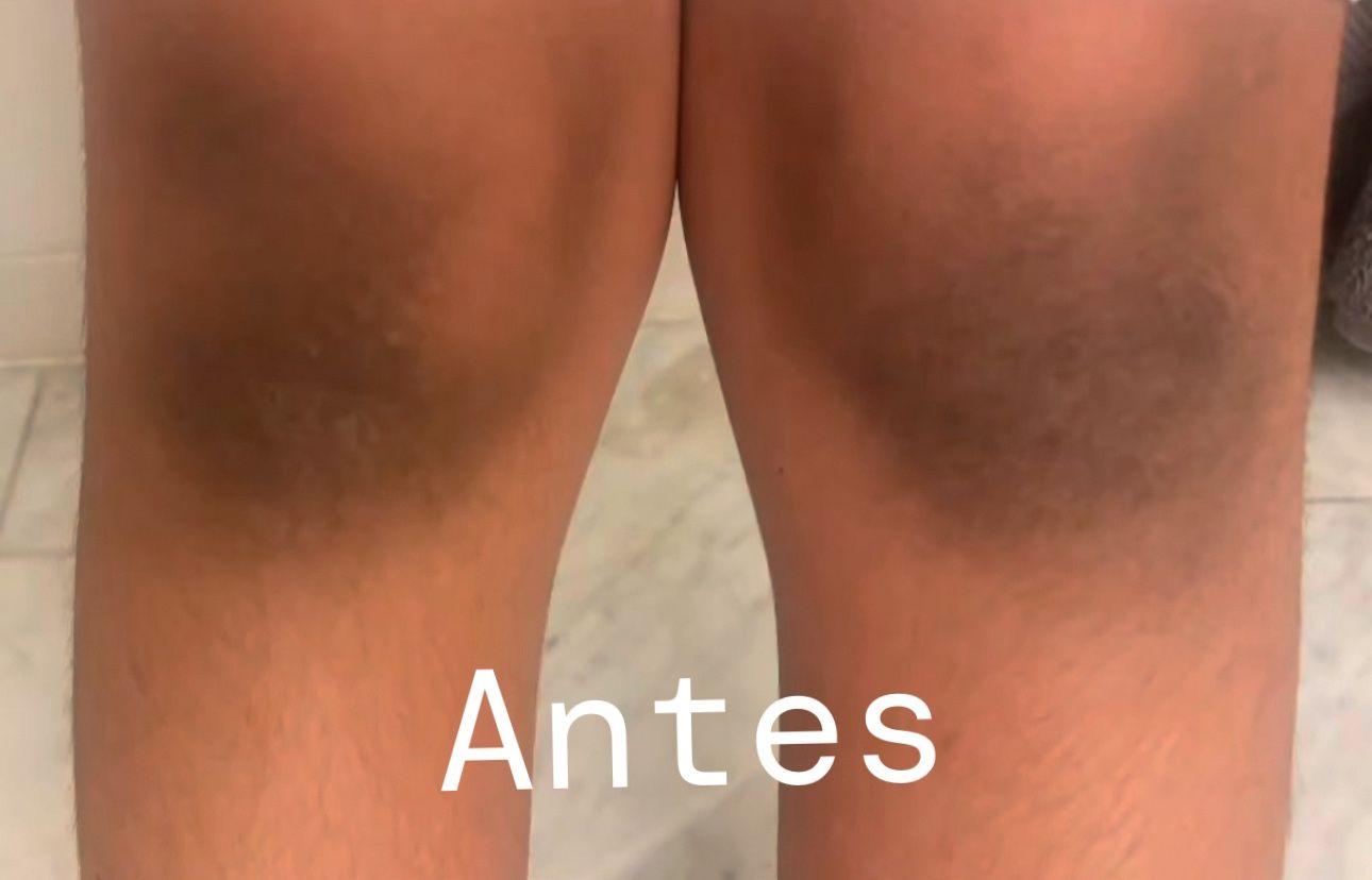 Microdermabrasion (área De Rodillas O Cuello)