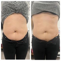 Cavitation Bundle