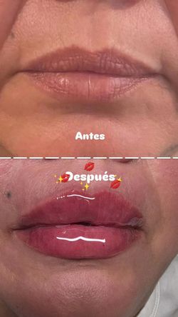 BOTOX EN LOS LABIOS PARA TENER UN EFECTO Voluptuoso Y Brillante