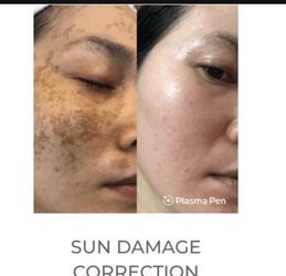 Fibroblast Plasma Pen.