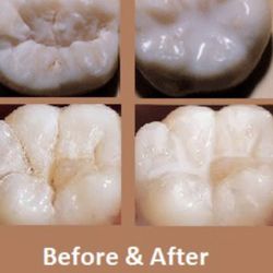 Free Dental Sealants registered dental assistant in training