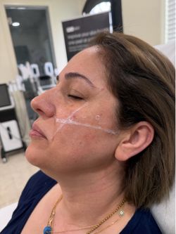 Cheek Filler