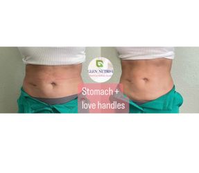 Body Sculpting Cavitation Radio Frequency And More