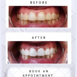 White Teeth