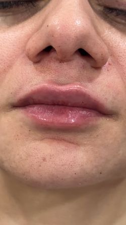 Lip filler