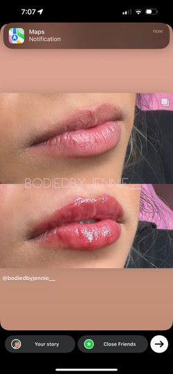 Lip Filler