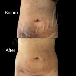 Post-op lymphatic care