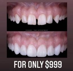 $999 Included 8 Teeth 