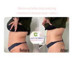 Body Sculpting Treatments