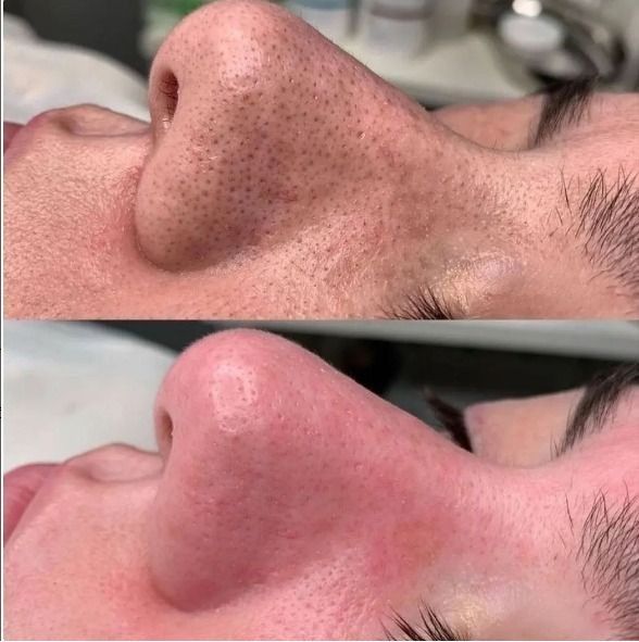 Faciales Profundos