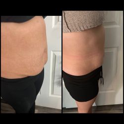 Lipo