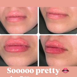 Lip Filler