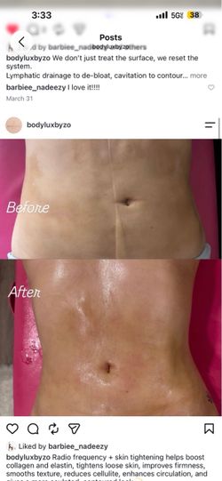 Body contouring lymphatic
