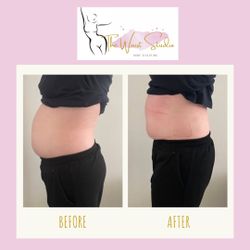 Body Fat removal