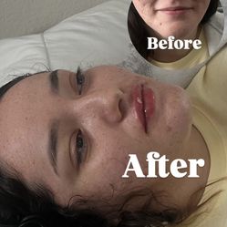 Lip fillers