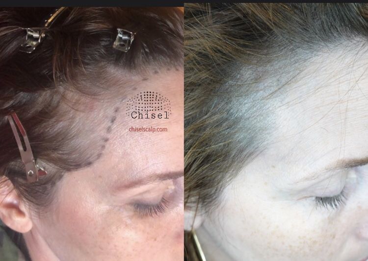 Scalp Micropigmentation (SMP)