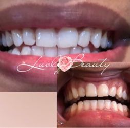 Teeth whitening